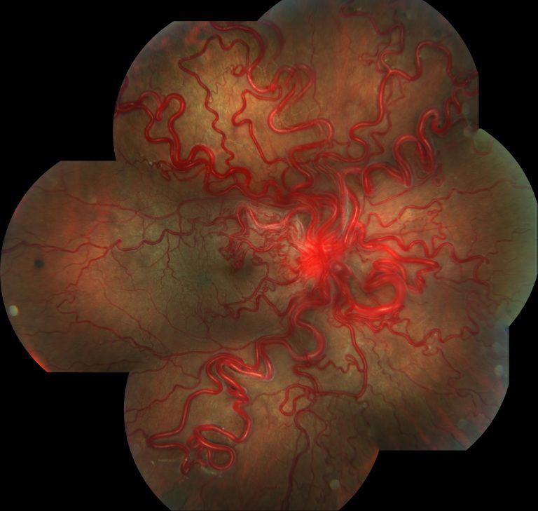 Retinografia A Cores Centro De Oftalmologia Avançada