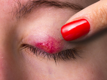 olho de mulher com ferida vermelha na pálpebra ilustra artigo sobre diferenças entre blefarite e conjuntivite